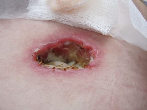 My belly button didn't want to take shape correctly. This was taken nearly two weeks after my surgery, and the hole continued spreading.