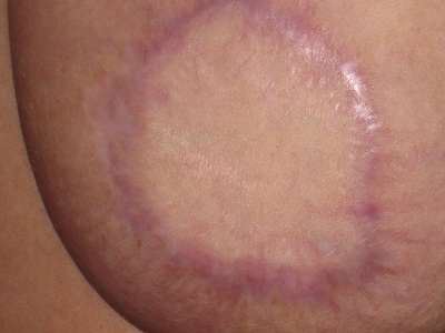 The scar tissue is thicker/broader in areas where more scabs formed during the healing process. There's barely any hardness remaining inside the bottom of the left breast.