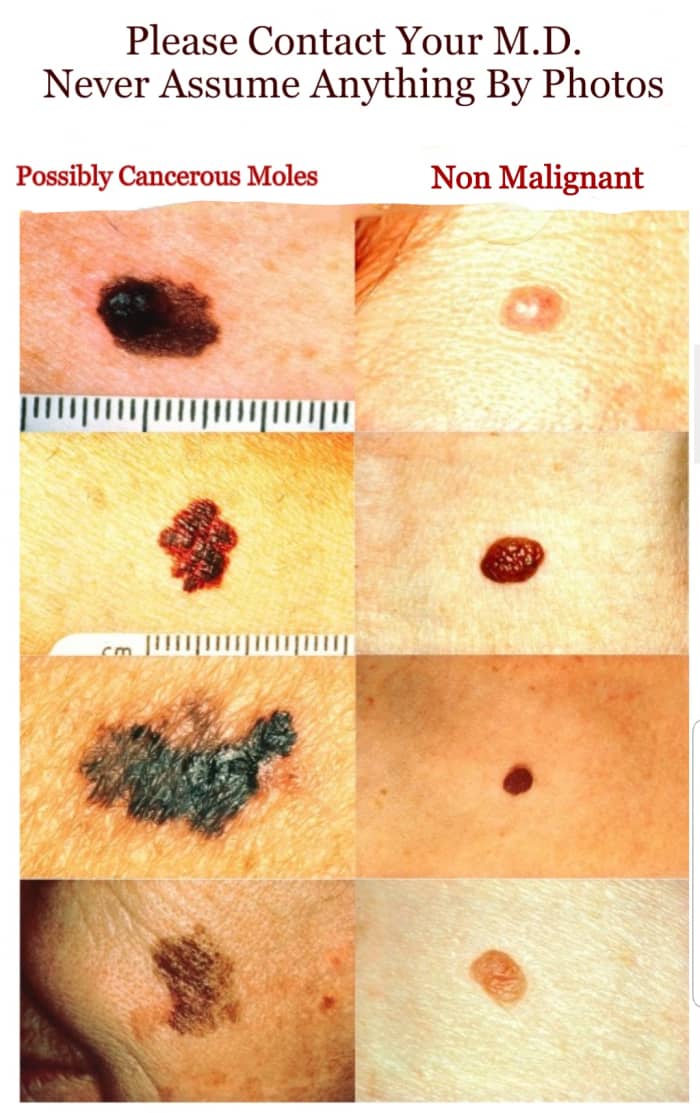 There are many types of moles—the ones pictured on the left might be cancerous, while the ones on the right are not. Use the ABCDE system to help you identify which is changing or concerning