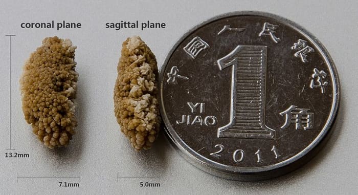 Kidney stones are small, but so is the ducts in your urinary tract. The jagged edges can scrape the walls and cause a great deal of pain as the stone is passed.