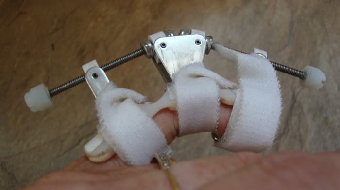 The screws are turned to put the finger in a bent position to keep the finger from stiffening completely. Ideally, it would be best to use this twice a day for about 20 minutes. The Voltaren gel below is used in conjunction with this device.