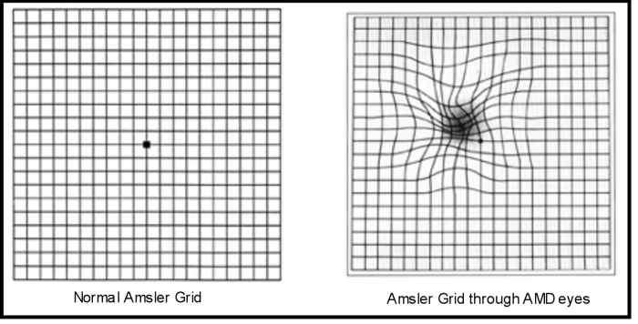 Losing My Eyesight to Age-Related Macular Degeneration (AMD) - HubPages