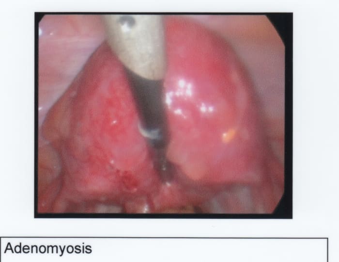 After 5 operations, and 1 course of Zoladex, 4 years of Mirena IUD, my endometriosis seems to be under control. However, worsening adenomyosis meant a 2nd course of Zoladex.