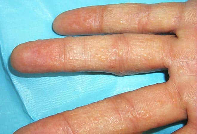 The additional chemicals (accelerator chemicals) and dyes added in the nitrile glove manufacturing process causes skin sensitivity in some people.