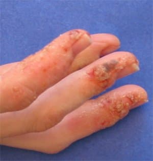 My skin condition began to dictate my life and personal hygiene routine. Soon, I couldn’t even bend my fingers without excruciating pain.