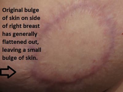 My right breast is a little larger than the left one, and it still has an extra chunk of skin that sticks out a little on the outside bottom edge. There's still a chunk of hardness remaining inside this breast.