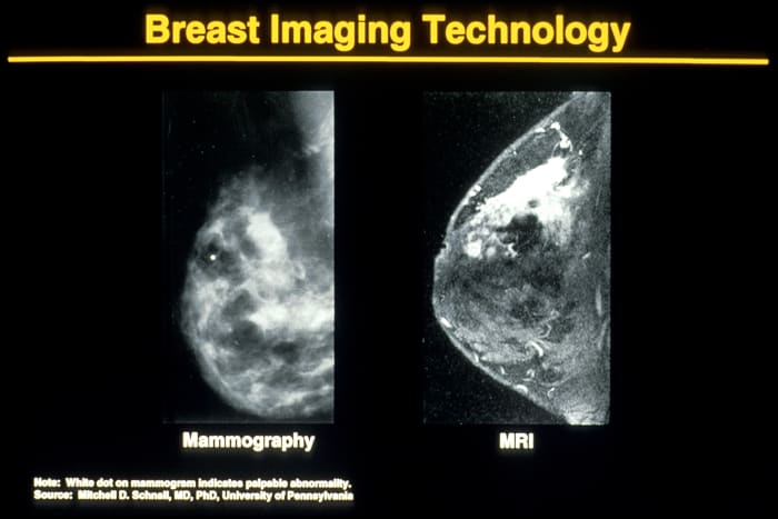 A mammography on left and a Magnetic resonance image (MRI) on right. Breast imaging technology has changed over the years. Note MRI's enhancement ability to confirm diagnosis.