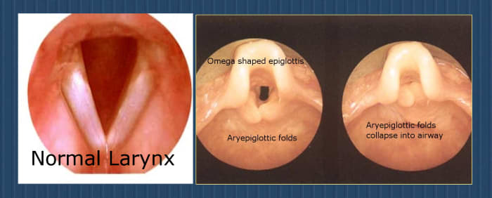 A normal voice box (larynx) is on the left. For children with laryngomalacia, the tissue above the vocal cords is floppy, collapsing inward when the child tries to breathe. This creates noisy breathing and sometimes causes serious complications.