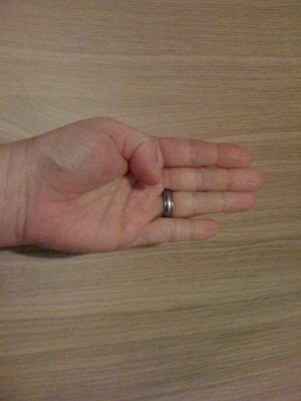 My Experience With Thumb and Wrist Pain (Includes Exercises) Patient