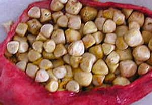 Believe it or not, those are gallstones, likely the cholesterol type due to their color. And they HURT!