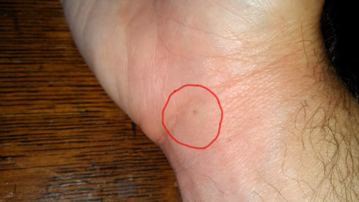 Bumblebee sting after 10 minutes (circled area). Swelling is beginning to fade away already.