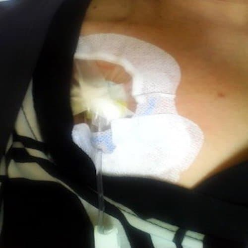 Here is my port being accessed by a chemo needle during the therapy. The nurse who did it was so gentle that I could not feel when he inserted the needle inside my port.
