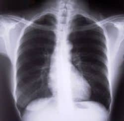 It is difficult to diagnose Tietze's Syndrome because even many medical practitioners are unfamiliar with it.