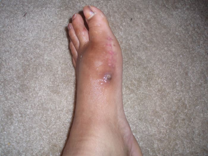 Eight weeks after surgery. The very dark area is where the metal pin rubbed against my skin and bruised it.