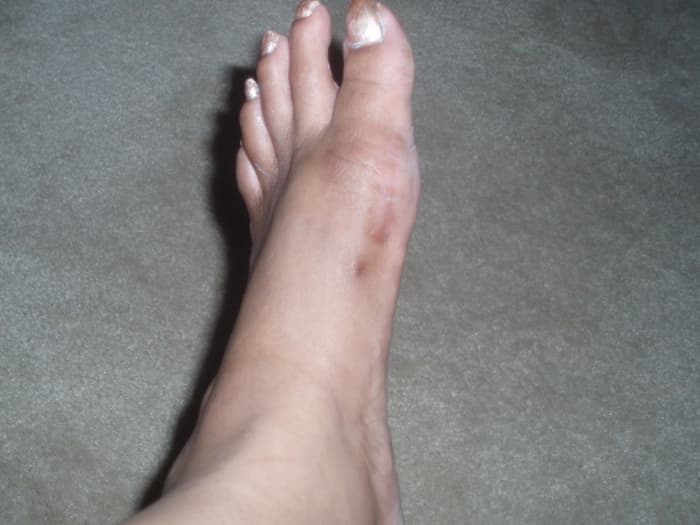 Six Months After My Bunion Surgery Recovery And Coping Strategies