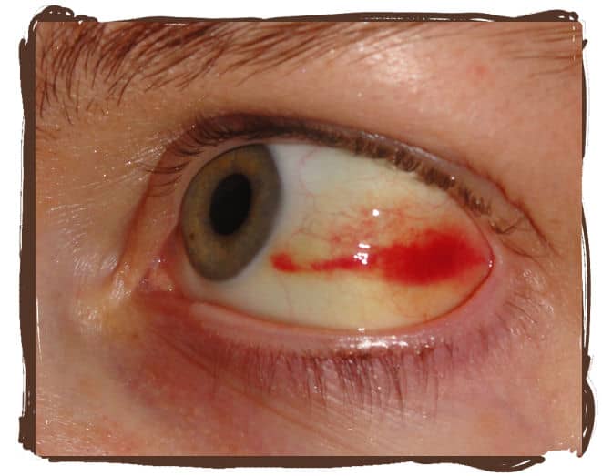 Some of the redness on top and bottom have started to clear, turning yellow, but the red is creeping towards my iris.
