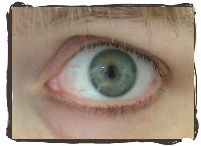 A little bit of red in the eye is normal. This is how my eye looks normally, and after completely healing.