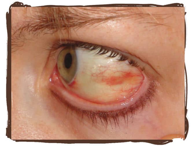 On day 5 my eye is still healing nicely. You can see how much of the red has gone away in just under a week. You can also see that there is still a little red spot near the iris.