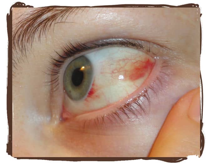 Day 4: You can see that most of the redness has started to heal. The small bit near my iris still remains with a healed portion between the two red patches.