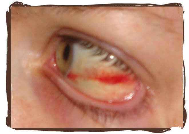 red ring around pupil of eye