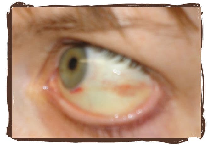 Day 6: Wow! What an improvement. My eye is starting to look almost normal again. Whew!