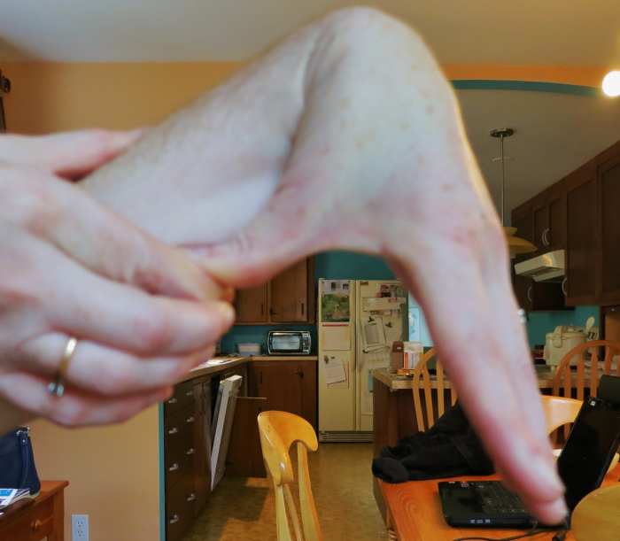 What Is EhlersDanlos Syndrome? My Story Patient's Lounge