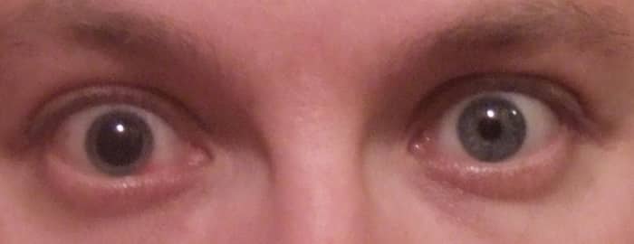For the next 10 days I would live with one dilated eye. Not really comfortable, but necessary for best results.