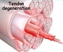 Cross-section of a degenerative tendon with tendinosis