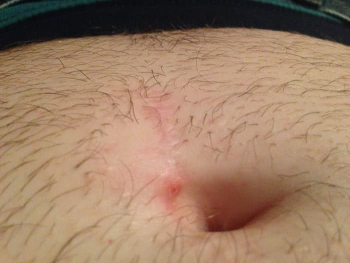 About two years after a colectomy, the scar is just barely visible. More importantly, my gut feels great (no more diverticulitis).