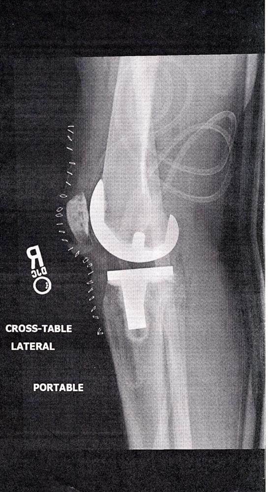 Knee x-ray, one day post-operative (side view). These days, they staple you back together; the staples clearly show in this x-ray