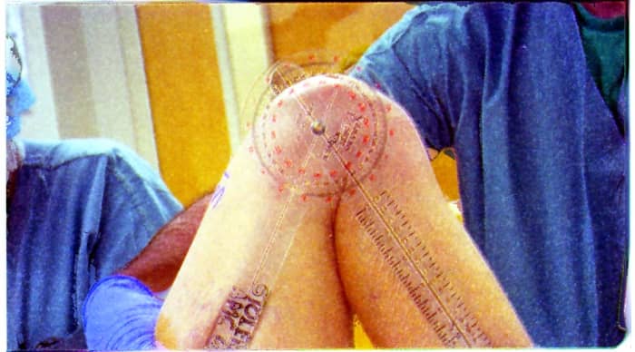 Manual manipulation under anesthesia is one solution if the physical therapy is not doing enough, or gets interrupted