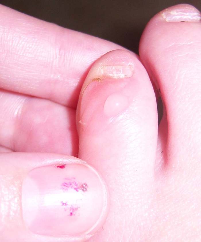 Once the blister was punctured, this clear fluid came out as pressure was reduced.