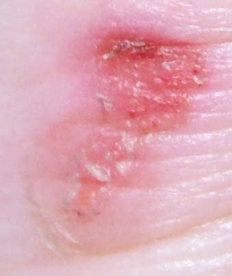 The broken blister on the back of my heel after a day's worth of healing. This happened just as we got back to the camp site.