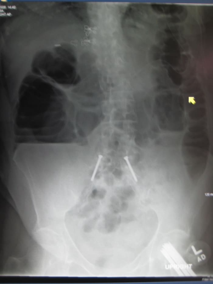An obstruction of the large intestine.
