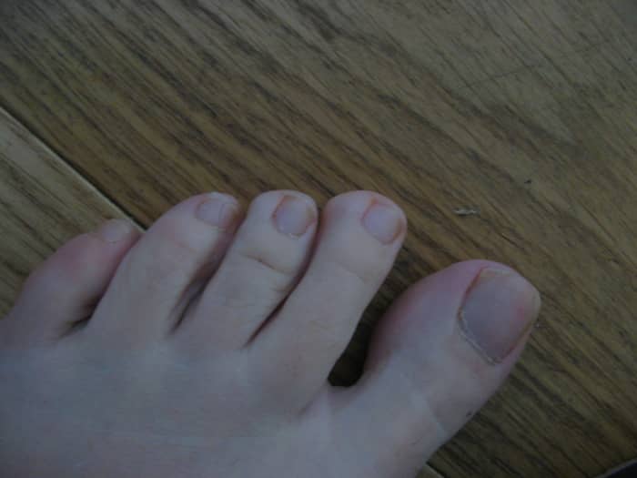 My toes nearly four years after fixing my low body temperature and increasing my vitamin C intake. There are no more fungal growths.