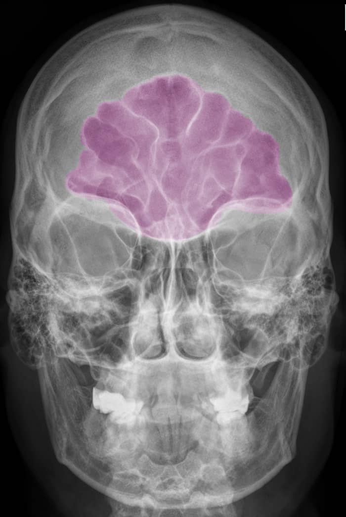 My mucocele was located in the far end of the frontal sinus over the end of my eyebrow. It was a very difficult area for the ENT surgeon to reach with an endoscope.