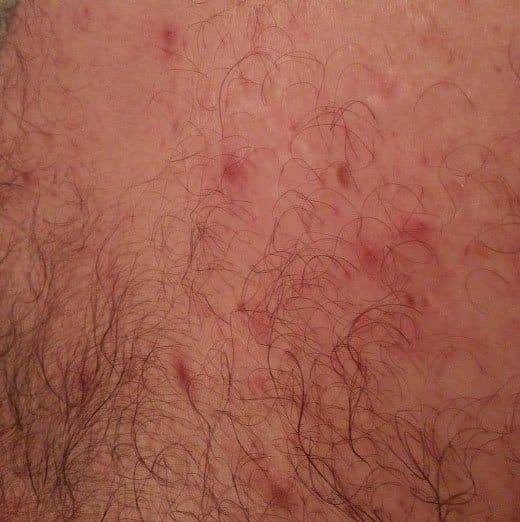 Tiny pimple-like clusters connected by silvery trails like these are where mites tunnel under the outer skin and leave an itchy, irritating rash.