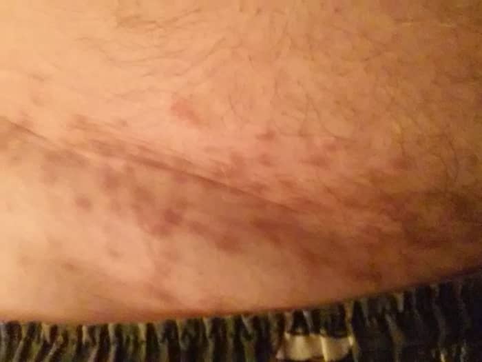 Three months later, signs of the blisters are merely dark spots on the skin. They're not actually scars, but they are still definite reminders of the viciousness of these mighty mites!