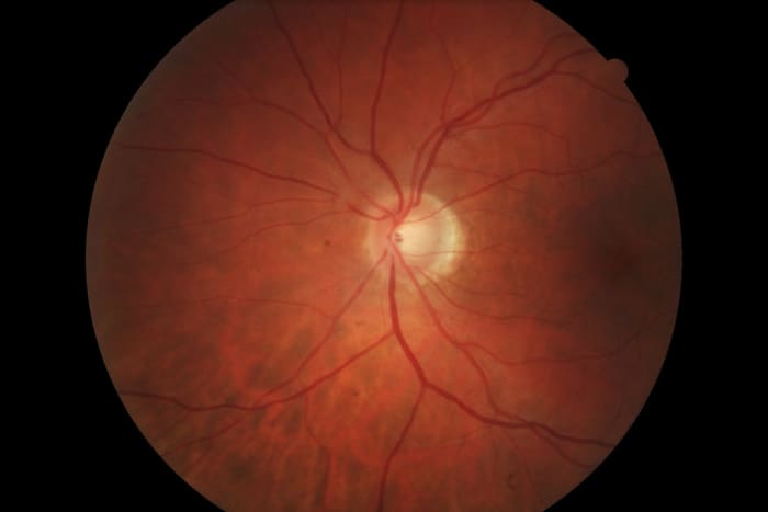 abnormal retinal scan
