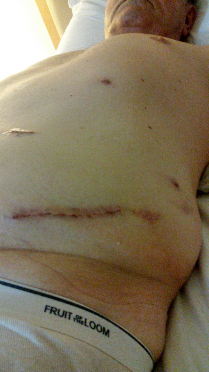 Scar from my left kidney removal operation. Picture taken in Bumrungrad Hospital around April 28, 2015, two or three days after the operation.