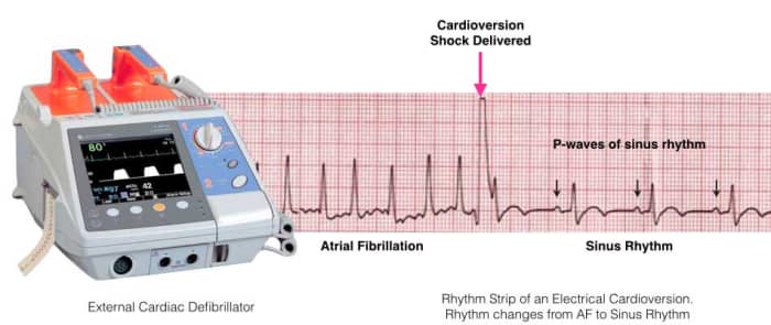 ECG showing the shock delivered in a cardioversion procedure in an attempt to restore regular heartbeats.