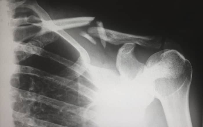 Question: Does PMR show up on an X-ray? Answer: PMR doesn't, but inflammation does. Still, doctors have other, more accurate ways of checking for inflammation.