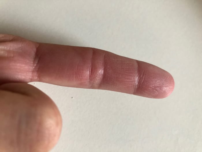 After four months of applying Neosporin and Mederma several times a day, and sunscreen before going outside, my external would has healed very nicely, and the scar is nearly invisible.