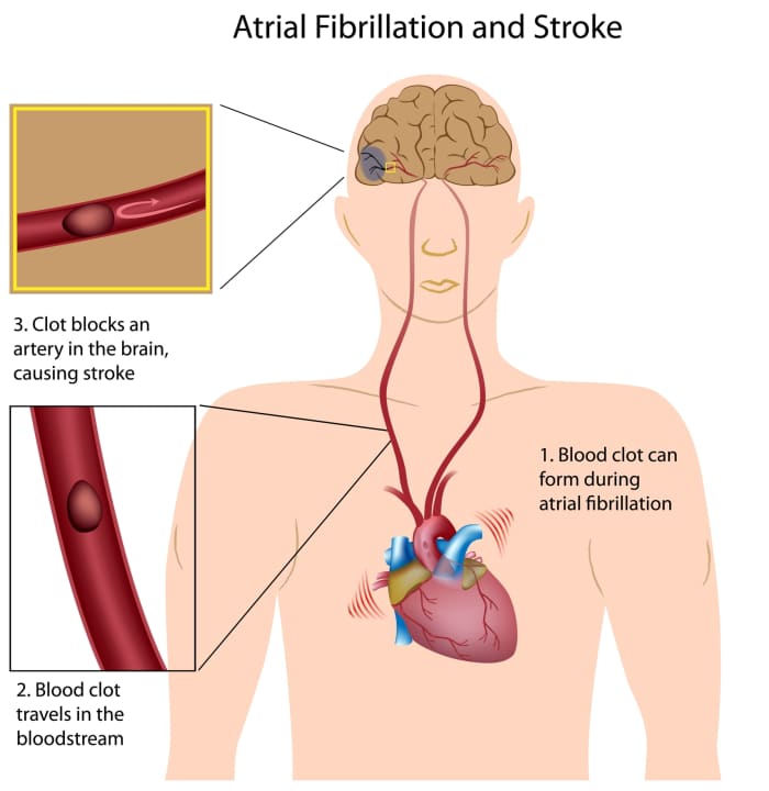A stroke victim has blood tests and a CT scan to determine the extent of the stroke (damage).
