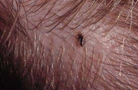 A Step-By-Step Guide to Naturally Getting Rid of Lice at Home - RemedyGrove