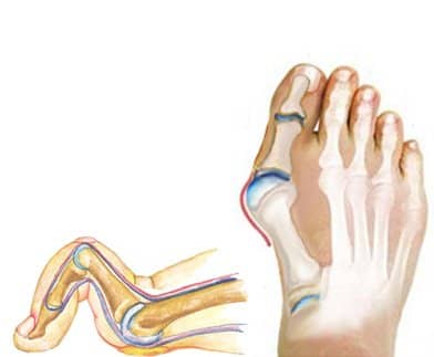 Left: Hammertoe: contraction/bending of a toe through lack of space in a shoe. Right: Bunion: sideways deviation of the big toe from wearing narrow shoes.