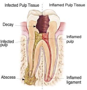 This is a technical drawling of a tooth with some information about the various things that cause toothaches.