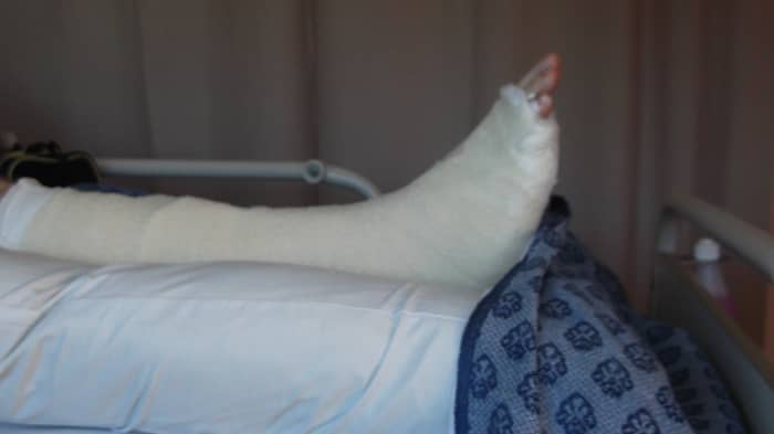 Even in a plaster cast, my husband's broken ankle looked smaller than immediately after his accident when his ankle was swelling.