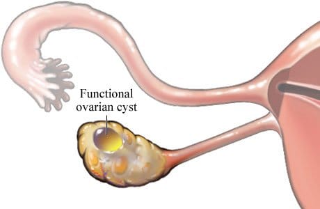 Ovarian cysts are generally benign, but in some cases, they can cause immense pain, nausea, and late periods.