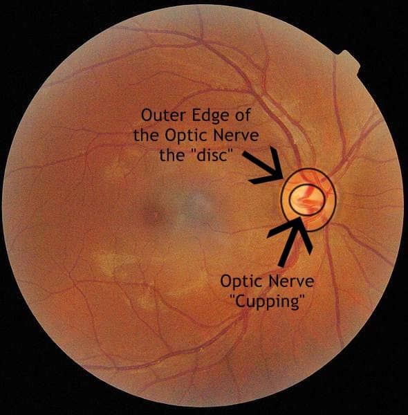 Increased pressure in the eye causes cupping of the optic nerve. Think of the optic nerve as a doughnut with the center hole being the cupping. Increased pressure in the eye causes that doughnut hole to grow, permanently damaging nerve fibers.